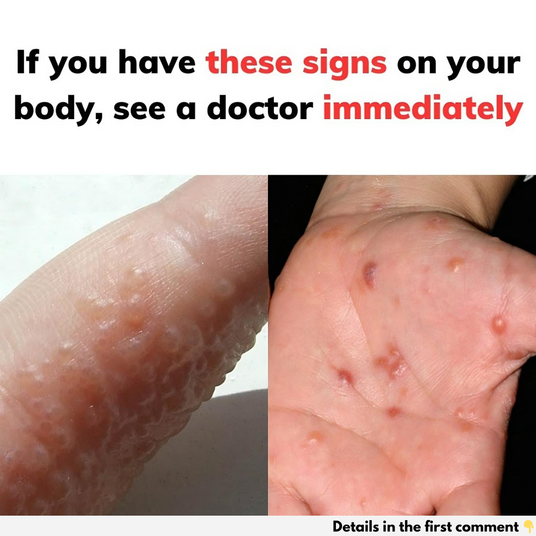 Dyshidrotic (Dyshidrosis) Eczema Dyshidrotic (Dyshidrosis) Eczema