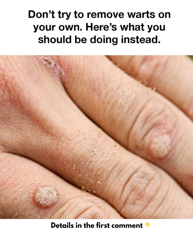 Don’t try to remove warts on your own. Here’s what you should be doing instead. Don’t try to remove warts on your own. Here’s what you should be doing instead.