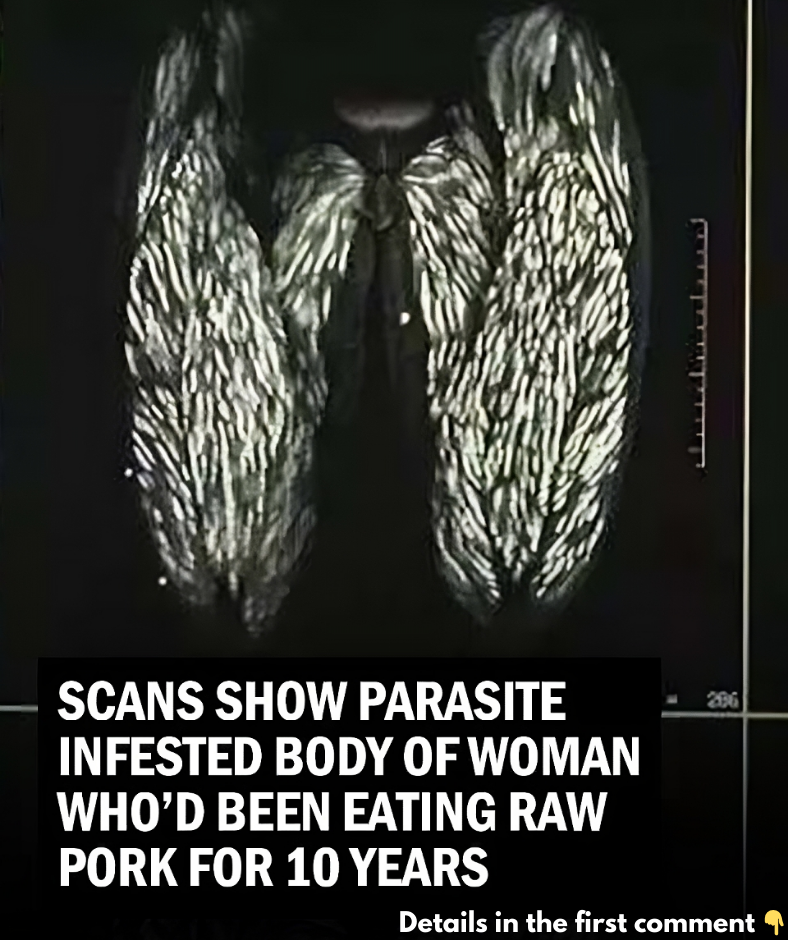 Scans Reveal Parasite-Infested Body of Woman Who Ate Large Amounts of Raw Pork for 10 Years Scans Reveal Parasite-Infested Body of Woman Who Ate Large Amounts of Raw Pork for 10 Years