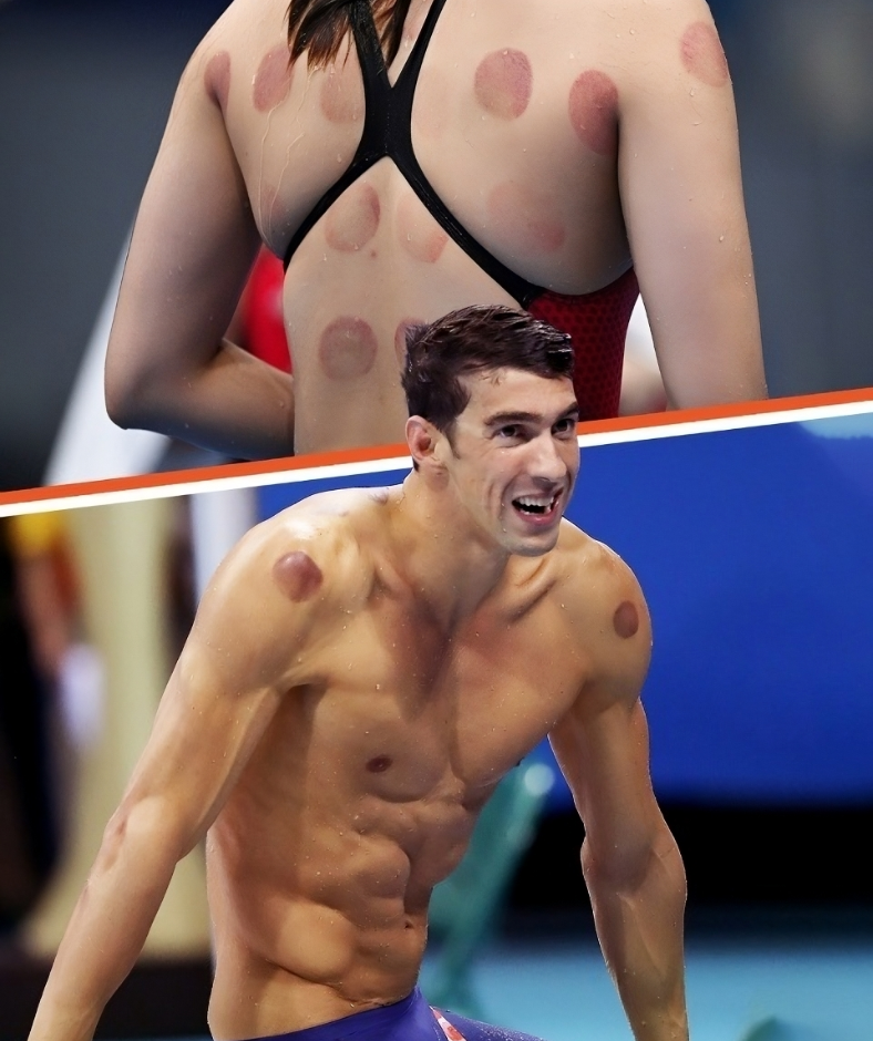 Why Were Olympic Athletes & Other Celebs Spotted with Dark Red Circles on Their Bodies? Why Were Olympic Athletes & Other Celebs Spotted with Dark Red Circles on Their Bodies?