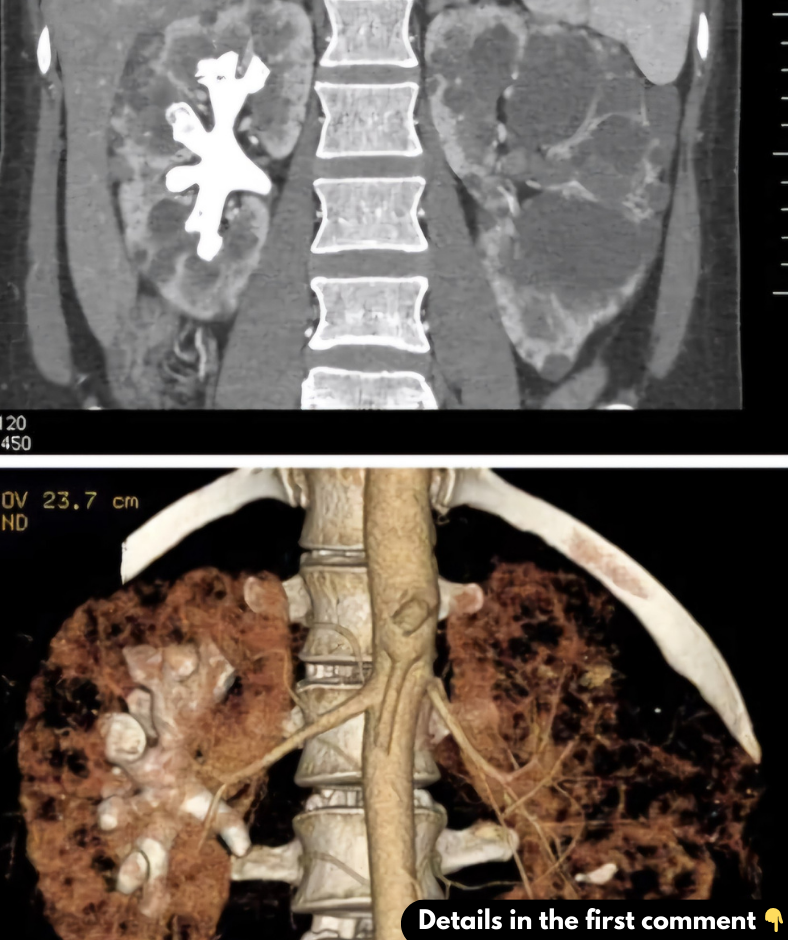 What Are Staghorn Kidney Stones? (Symptoms, Causes, and Treatment)  What Are Staghorn Kidney Stones? (Symptoms, Causes, and Treatment)