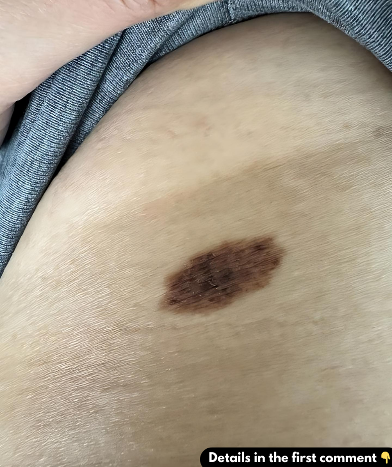 I have this mole that has patchy dark spots on it. What should I do? I have this mole that has patchy dark spots on it. What should I do?