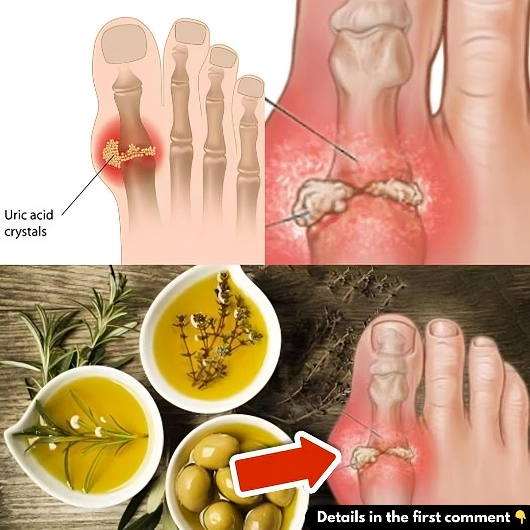 Easy Ways to Remove Excess Uric Acid That Easier Than You Think…