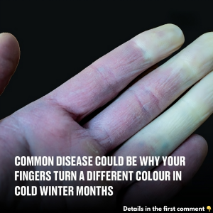 Common disease could be why your fingers turn a different colour in cold winter months