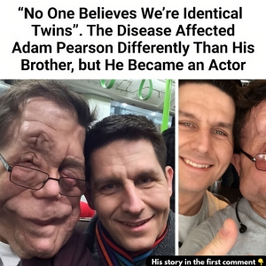 “No One Believes We’re Identical Twins”. The Disease Affected Adam Pearson Differently Than His Brother, but He Became an actor