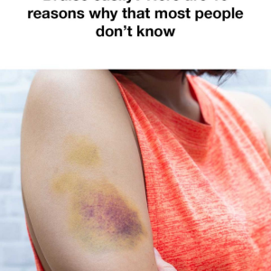 10 Reasons Most People Bruise Easily