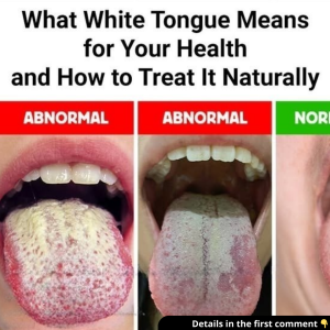 What White Tongue Means for Your Health and How to Treat It Naturally