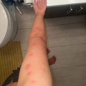 I have no idea what these are does anyone know what l’ve been bitten by, please? I have two on the other side as well