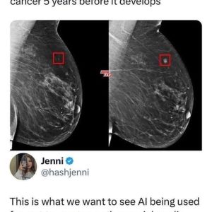 AI Breakthrough Detects Breast Cancer 5 Years Early — This Is the Future We Truly Need
