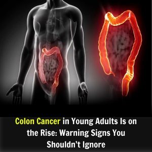 Colon Cancer in Young Adults Is on the Rise: Warning Signs You Shouldn’t Ignore