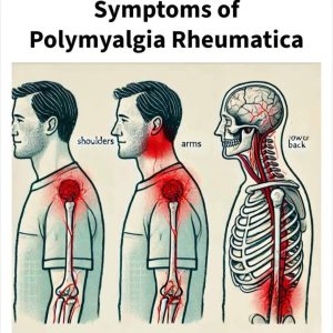 Important Signs To Look For That Could Suggest You Have Polymyalgia Rheumatica