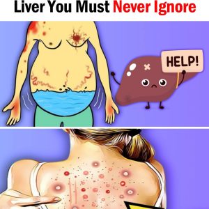 Fatty Liver: Causes, Symptoms, Treatment & Home Remedies