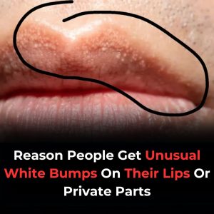 Why You Might See Unusual White Bumps On Your Lips Or Genitals