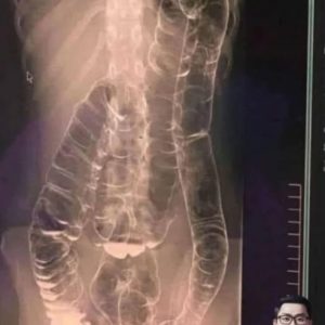 Here’s What You Need To Know About Chronic Constipation: A Silent Killer To Your Digestive Health