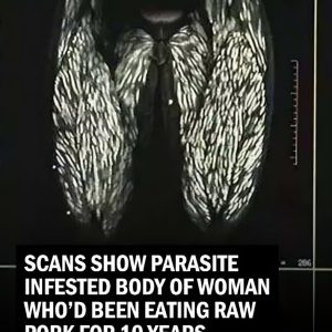 Scans Reveal Parasite-Infested Body of Woman Who Ate Large Amounts of Raw Pork for 10 Years
