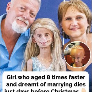 Beandri Booysen: Girl in South Africa with progeria d*es