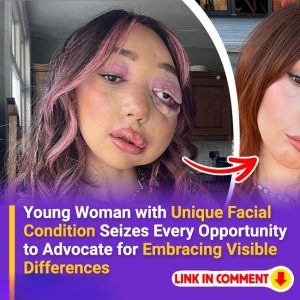 Young Woman with Unique Facial Condition Seizes Every Opportunity to Advocate for Embracing Visible Differences