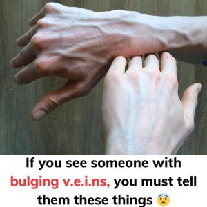 If You Notice Someone with Bulging Veins, You Should Tell Them This Right Away