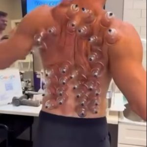 Have You Tried Cupping? Here’s What You Need to Know About the Ancient Practice…