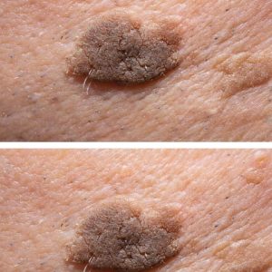 This mole-like spot is growing but doesn’t hurt. Doctor appt is far away. What should I do?