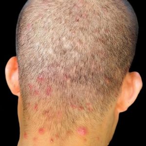 We tried switching shampoos, but this keeps flaring up on my son’s scalp. What else helps scalp breakouts?