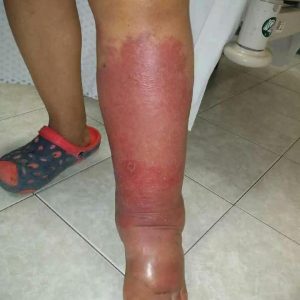 How I Got Rid of Swollen Ankles, Feet, and Legs — Without Medications